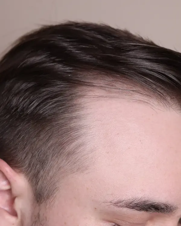 La Estrategia de Precisión: Protocolos Integrados de Nutrientes y Fitoterapia para el Control de la Alopecia.